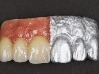 protheses-fixes-chromadent-04_13.jpg