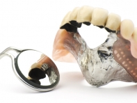 implant dentaire squelette métallique